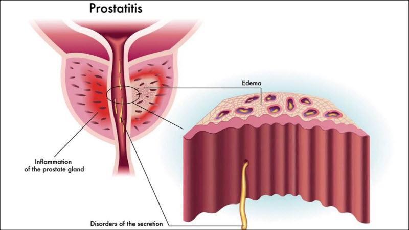 پروستاتیت یا التهاب پروستات چیست؟ چه علایم و نشانه هایی دارد؟ راه های تشخیص و درمان آن